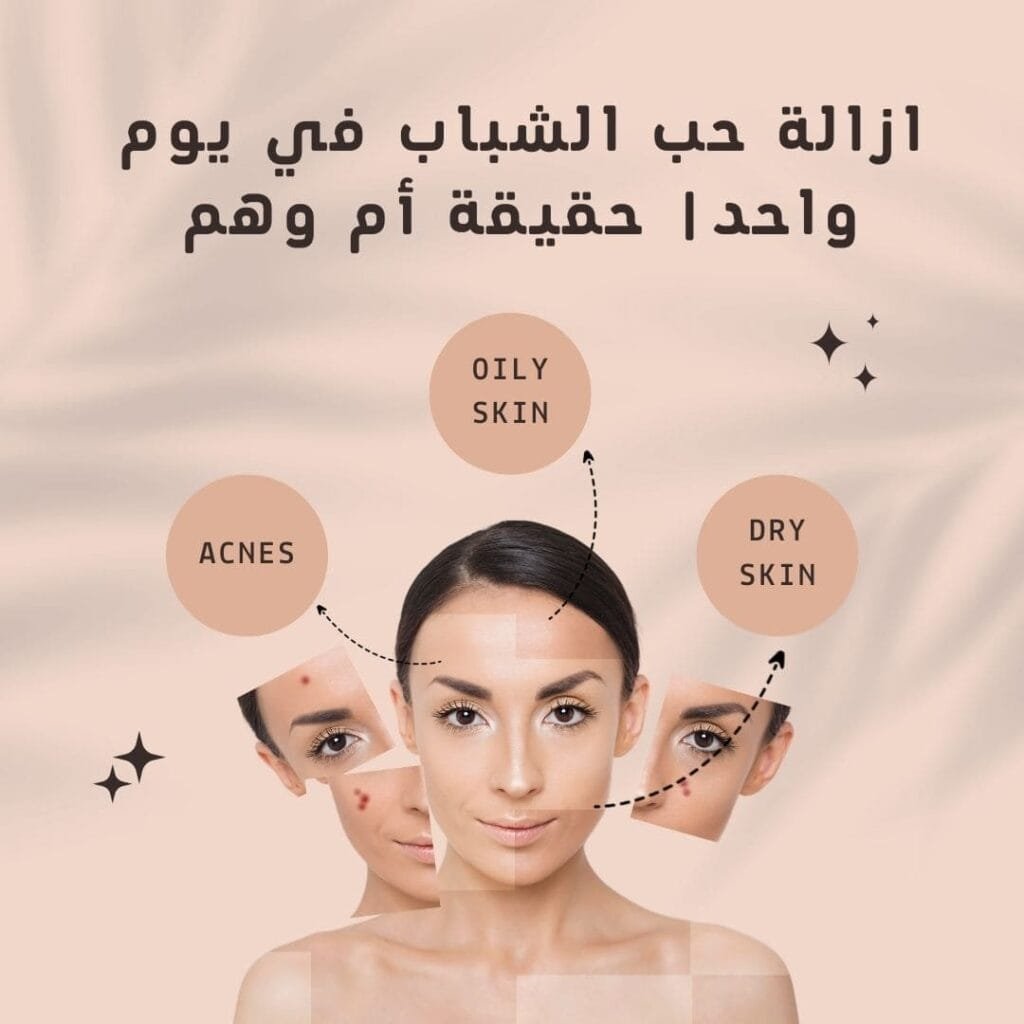 ازالة حب الشباب في يوم واحد| حقيقة أم وهم