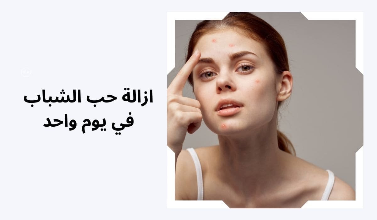 ازالة حب الشباب في يوم واحد