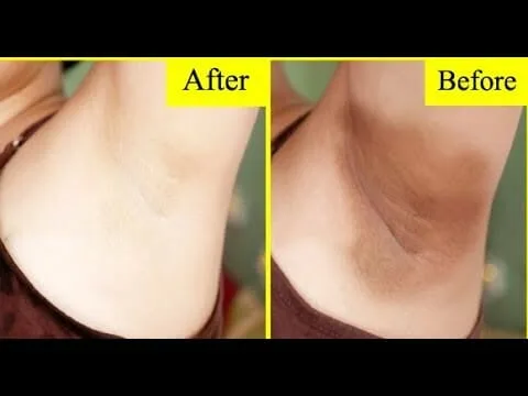 5 وصفات طبيعية لتبييض المناطق الحساسة 2 وصفات طبيعية لتبييض المناطق الحساسة
