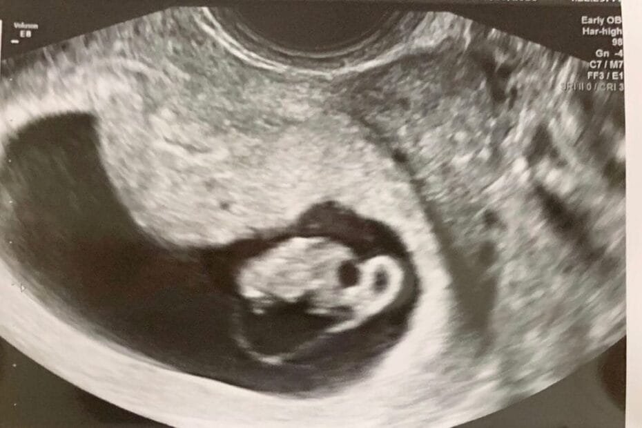 شكل كيس الحمل بعد الإجهاض في الشهر الثاني