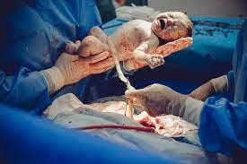 Benefits of caesarean section