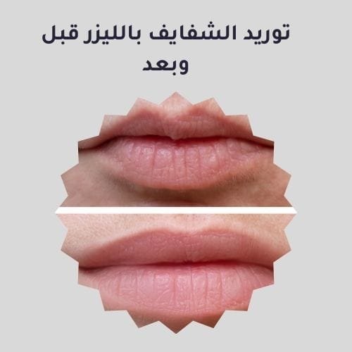 توريد الشفايف بالليزر قبل وبعد
