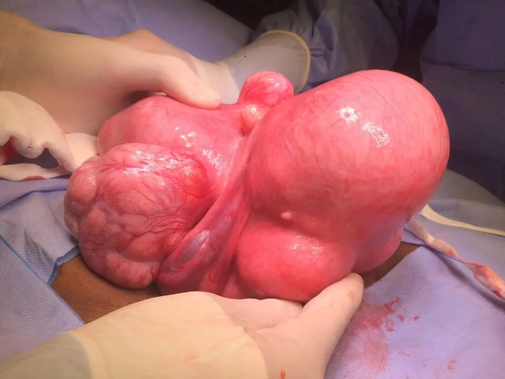 الشفاء من تليف الرحم