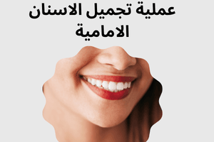 عملية تجميل الاسنان الامامية